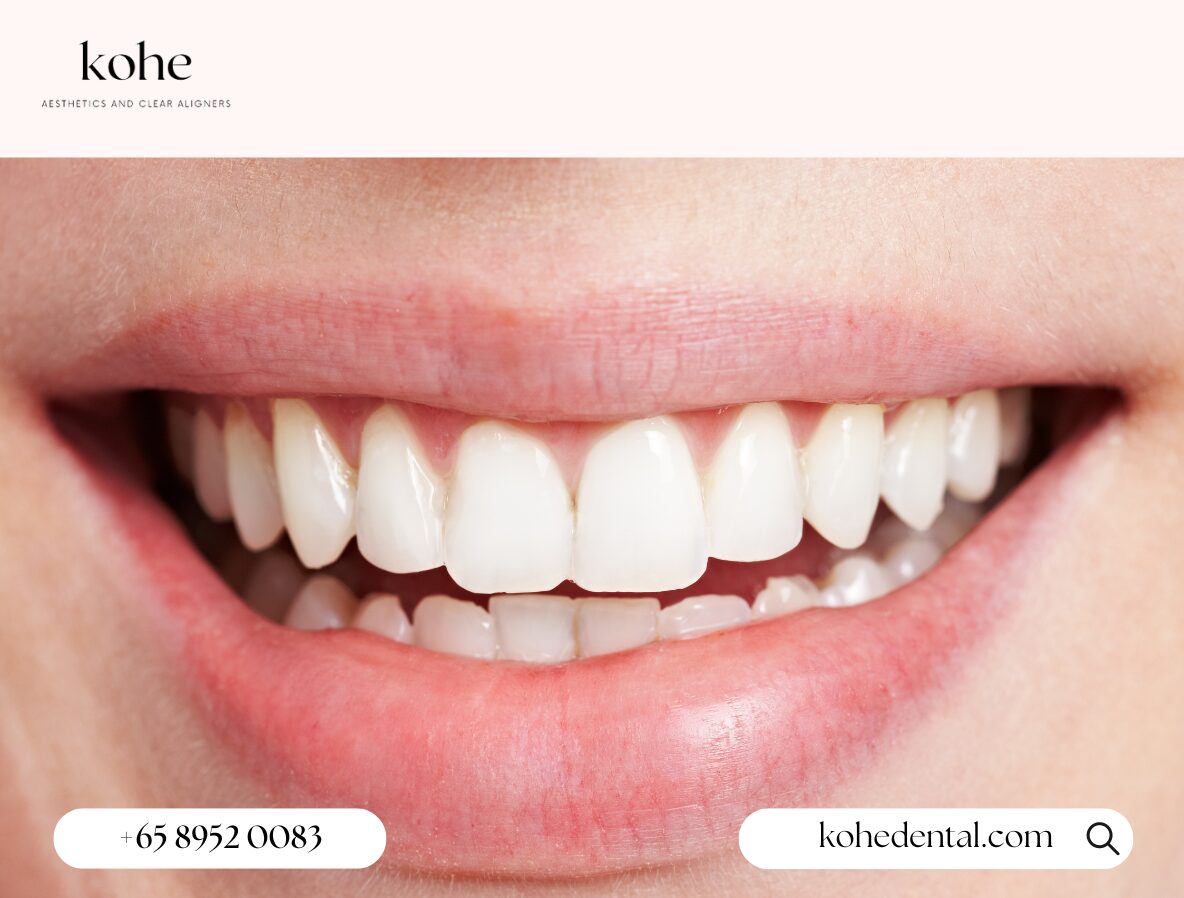 Straighten Teeth Quickly But Safely - kohe Dental