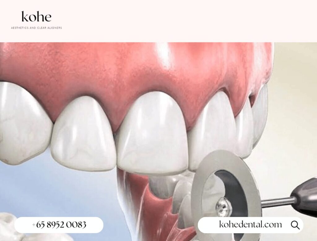 3D Visualisation of a Patient Receiving InterProximal Reduction (IPR) Treatment - kohe Dental