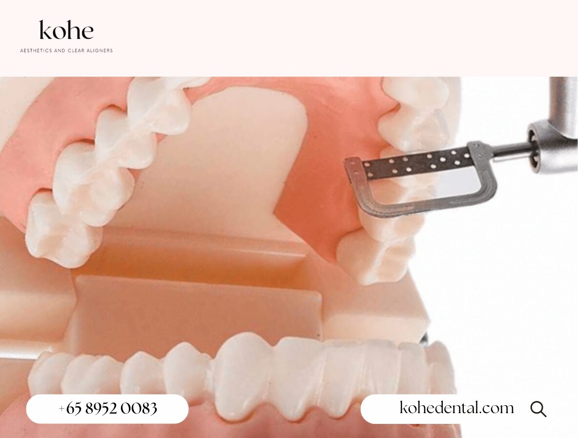 Interproximal Reduction (IPR) of Teeth Before Clear Aligners - kohe Dental