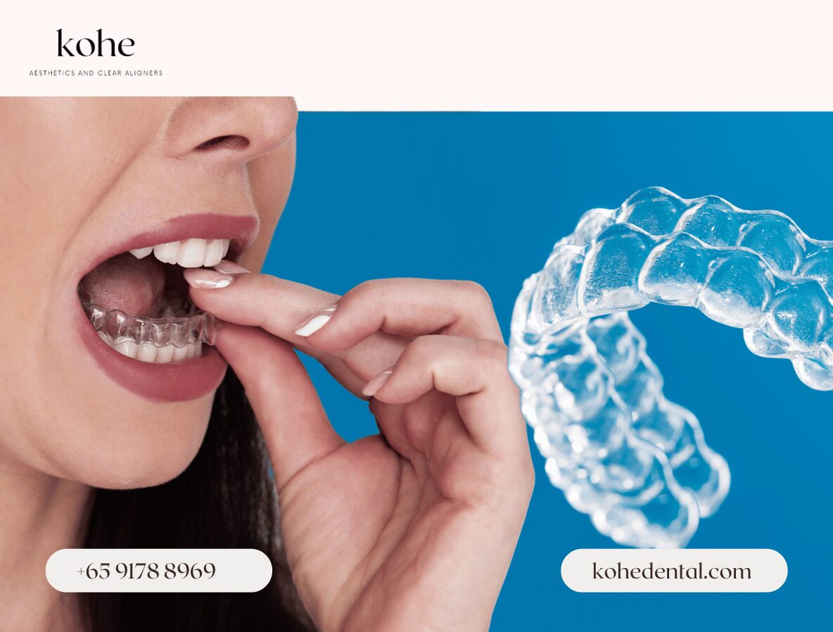 Burning Questions About Angel Aligner Answered by a Dentist! [Part 1