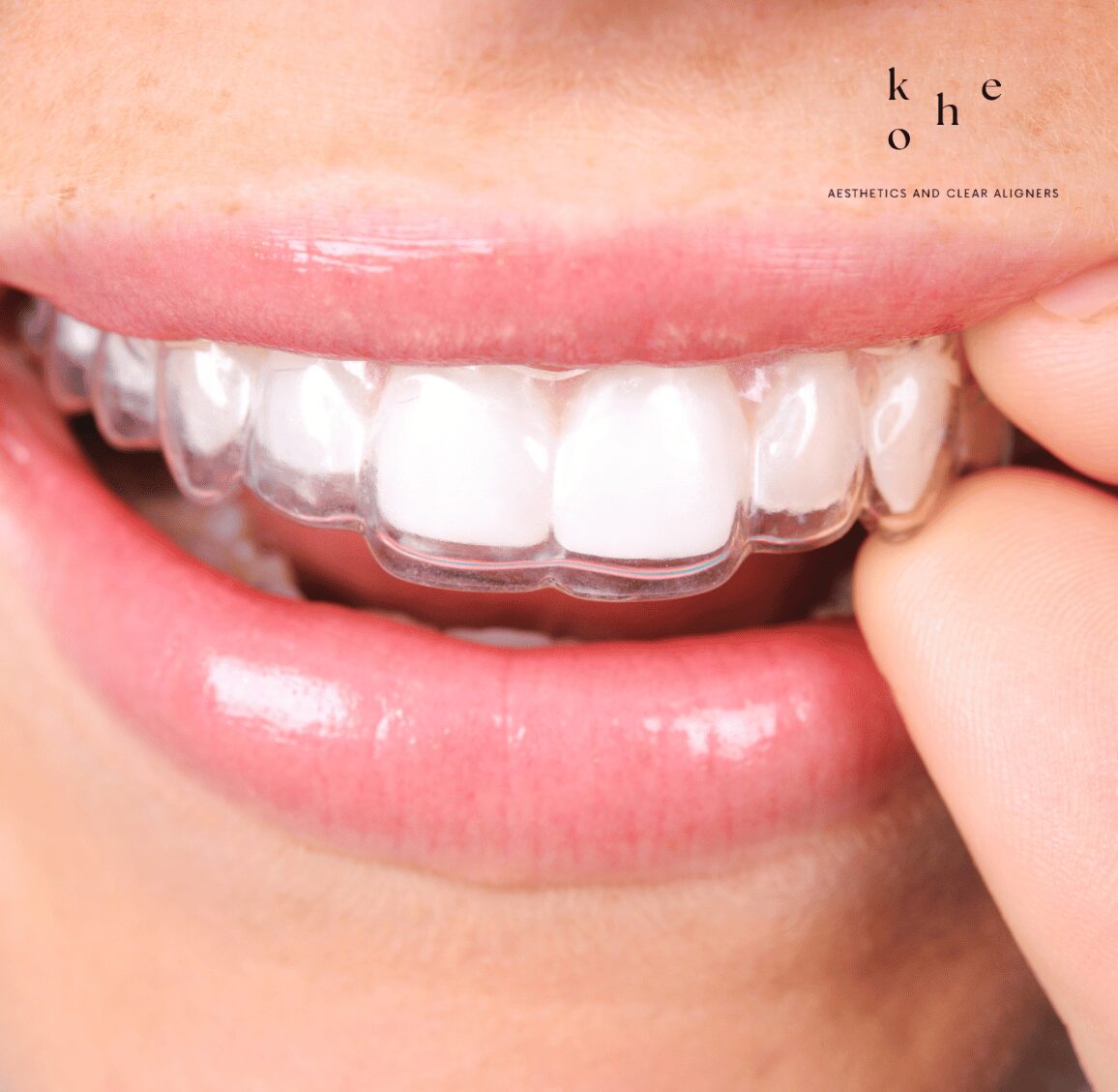 Discreet and Comfortable Clear Retainers - kohe Dental