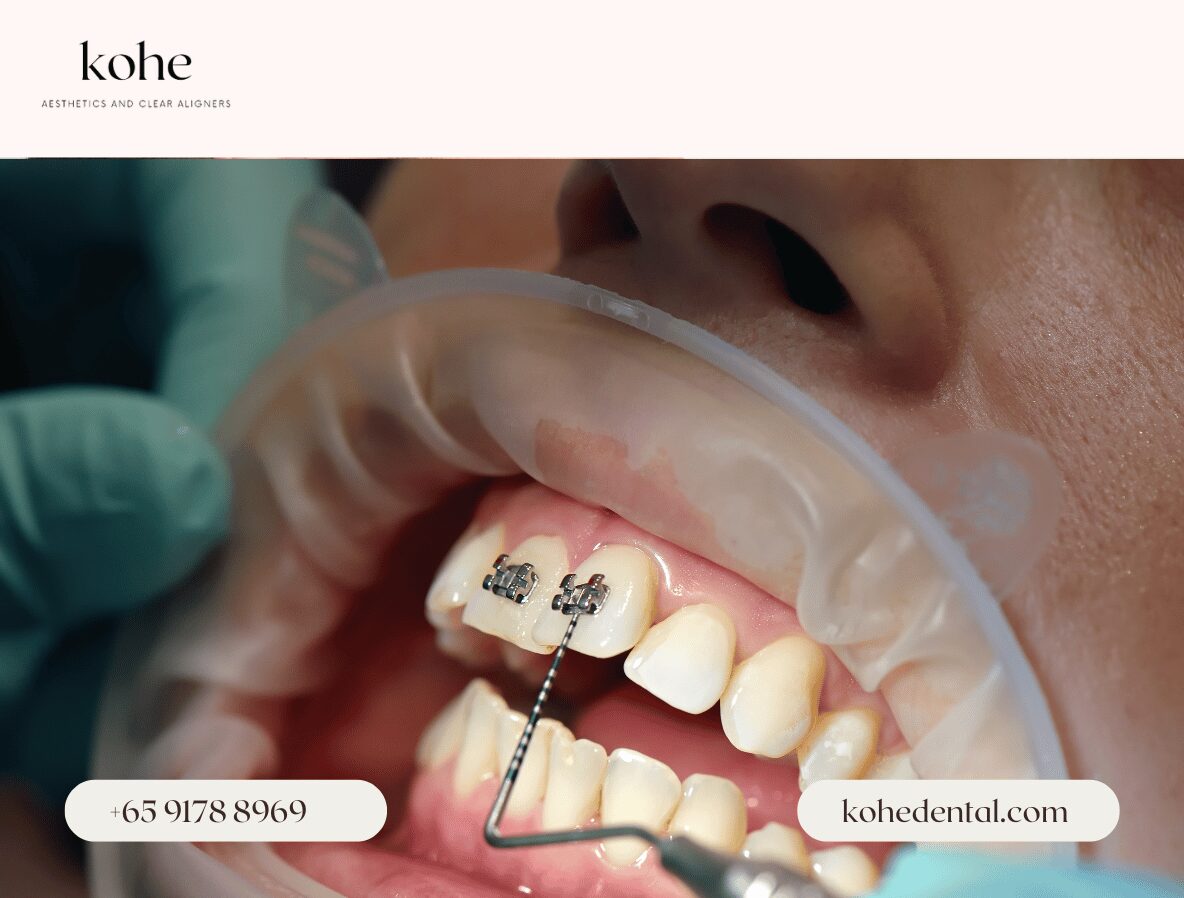 Metal Braces Placement - kohe Dental