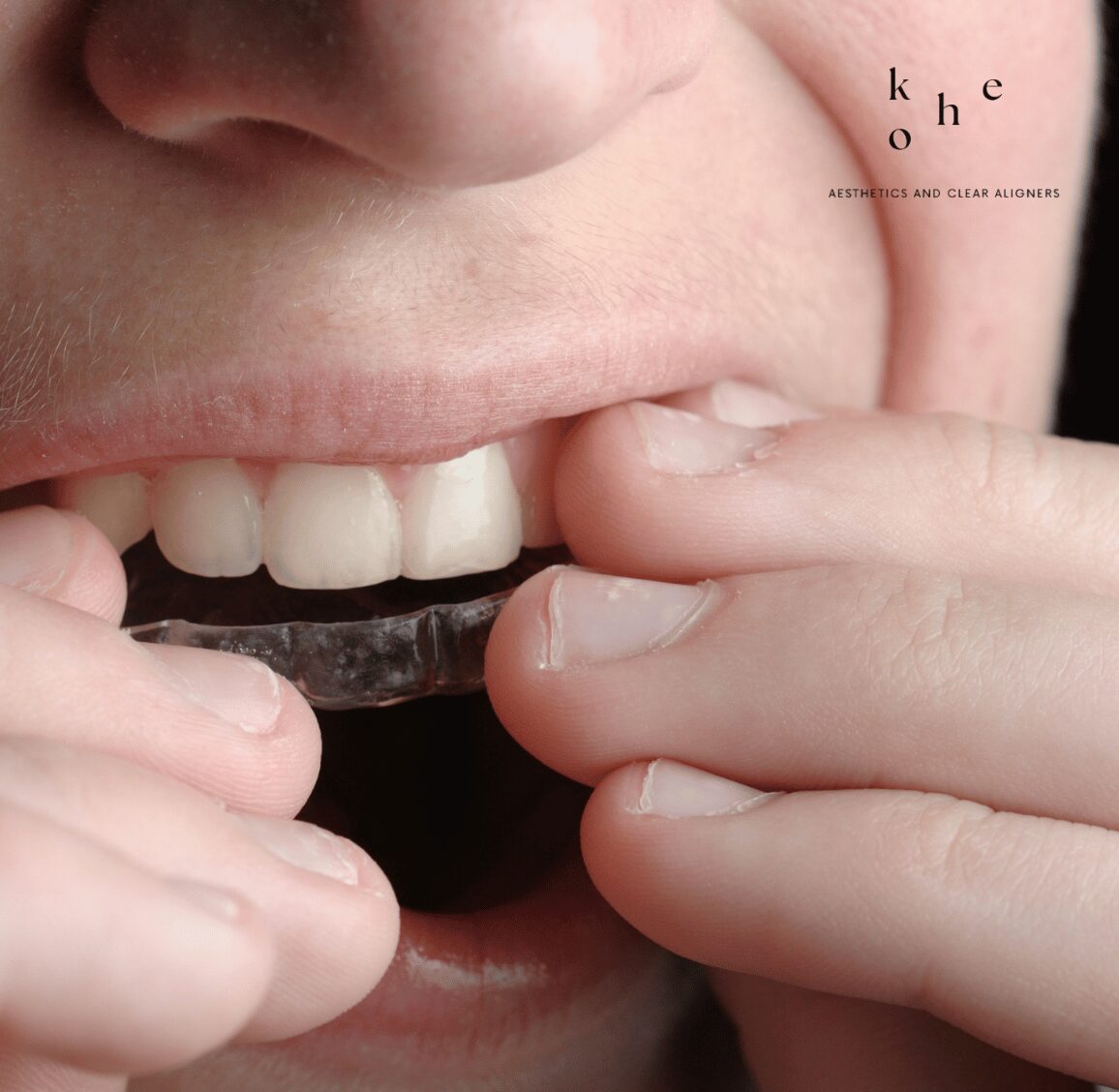 Precise Clear Retainers - kohe Dental