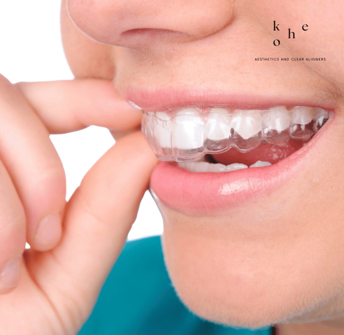 Removable Clear Retainers - kohe Dental