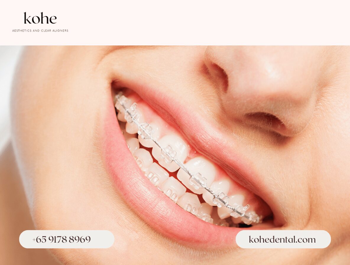 Self Ligating Clear Braces - kohe Dental