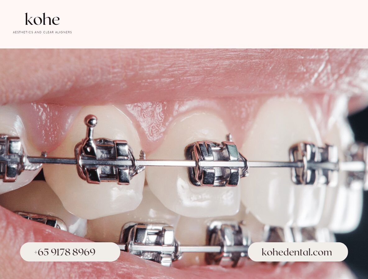 Self Ligating Metal Braces - kohe Dental