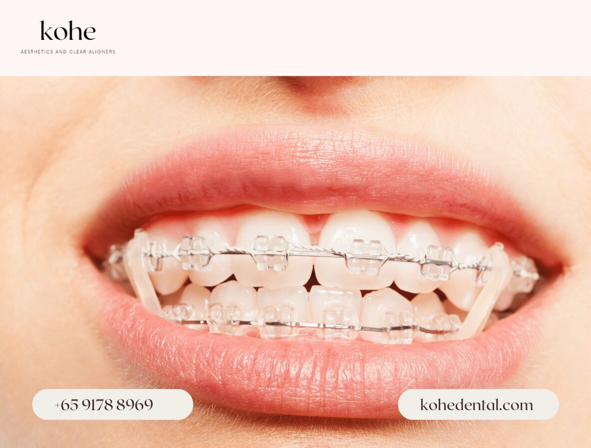 Traditional Ceramic Braces - kohe Dental