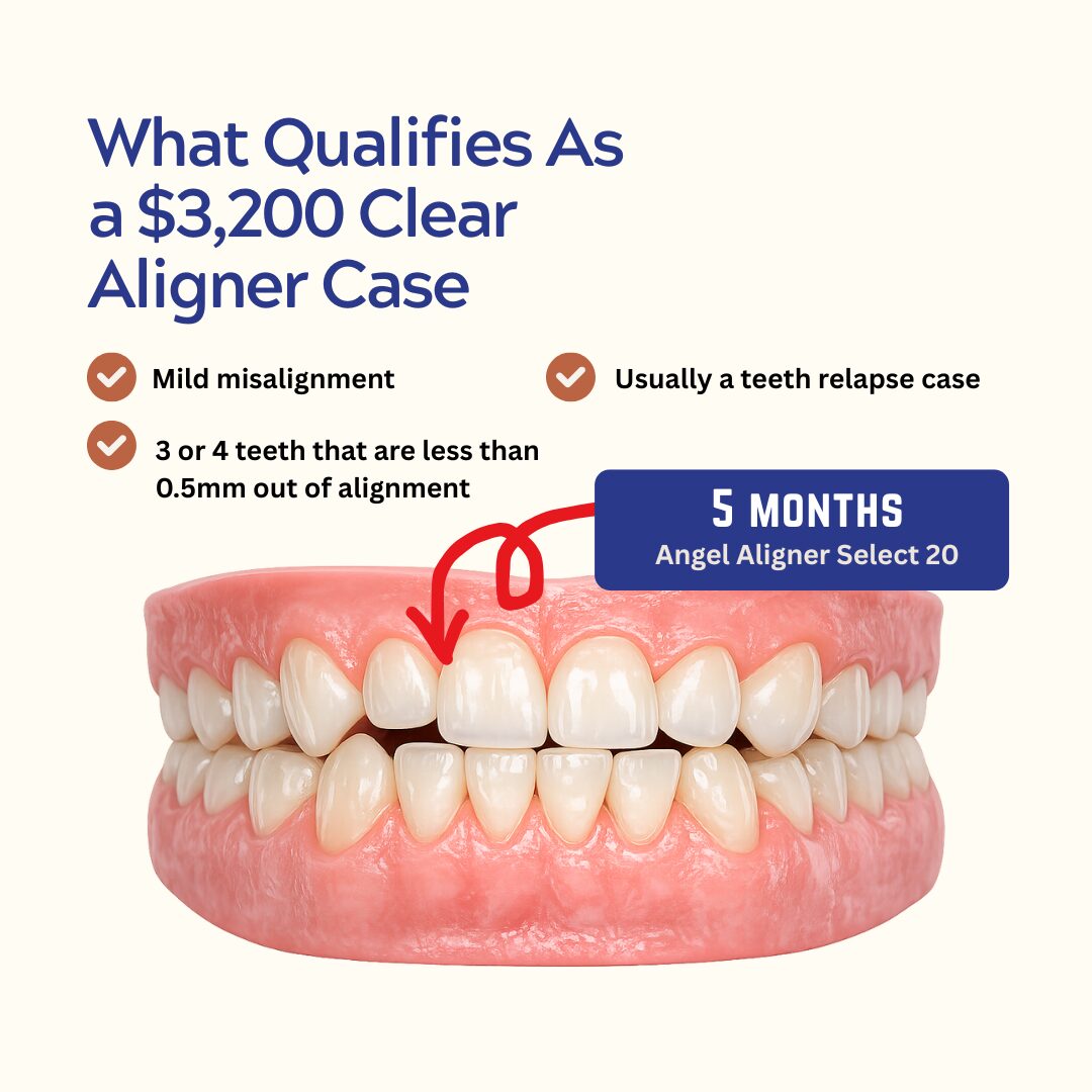 Angel Aligner Select 20 Suitability - kohe™ Dental