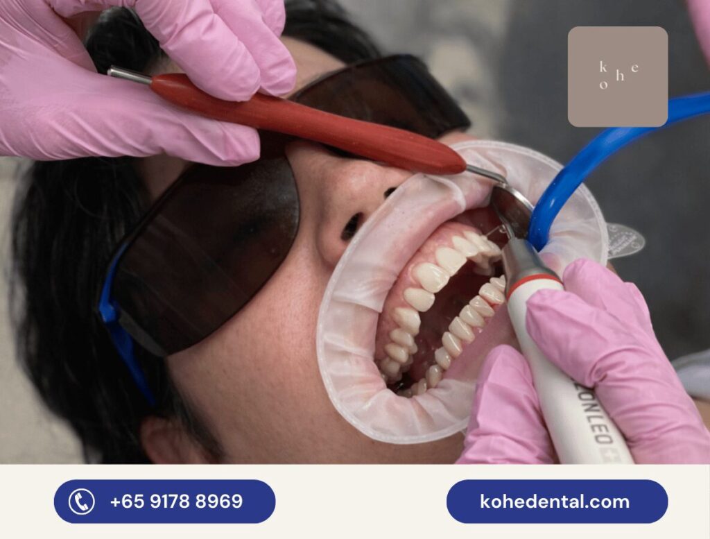 Patient Undergoing Guided Biofilm Therapy After Braces - kohe™ Dental