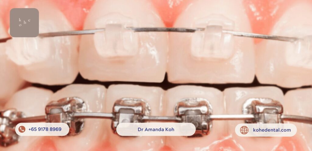 Affordable Hybrid Braces - kohe™ Dental