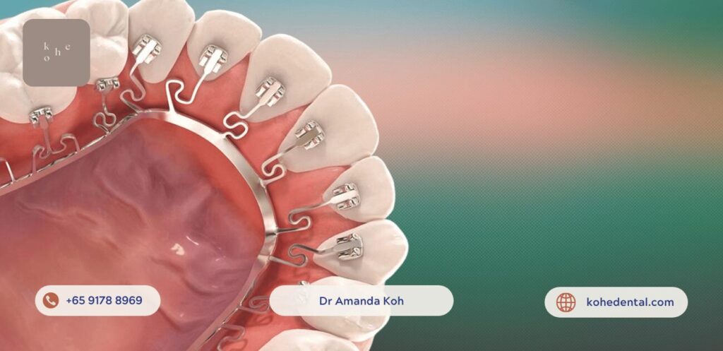 Affordable Lingual Braces (Brava by Brius) - kohe™ Dental