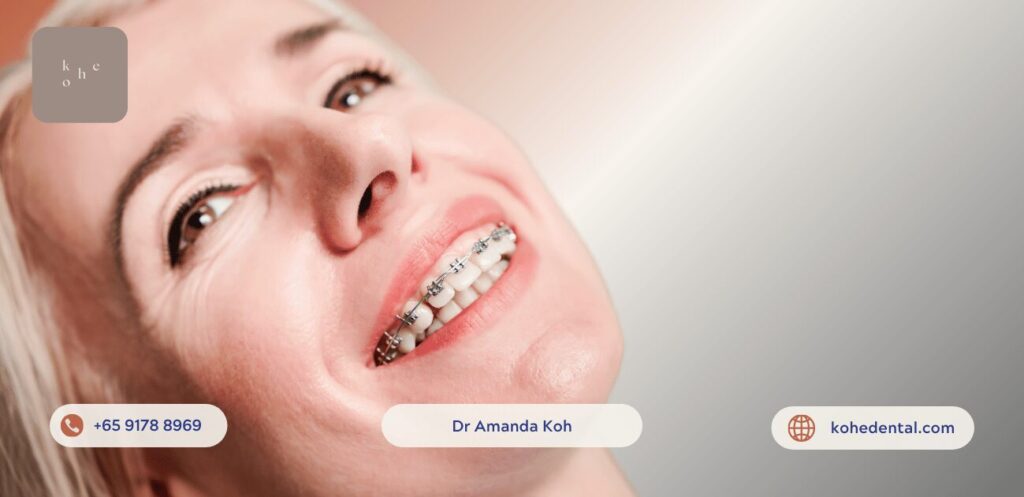 Woman Who Did Not Delay Braces Treatment - kohe™ Dental