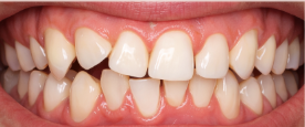 Moderate-Complex Misalignment - kohe™ Dental