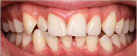 Complex Misalignment - kohe™ Dental