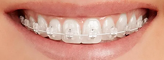Ceramic Self-Ligating Braces - kohe™ Dental