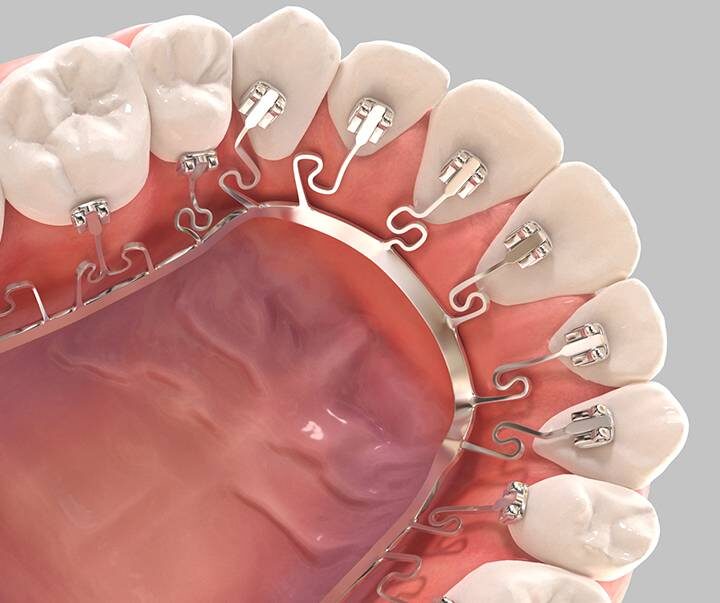 Brava by Brius Lingual Braces - kohe™ Dental 