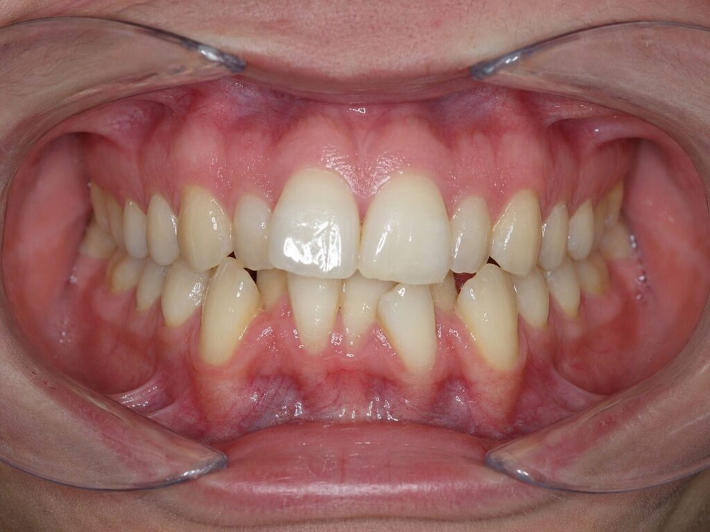 Overcrowding can be spotted over a clear aligner photo assessment - kohe™ Dental
