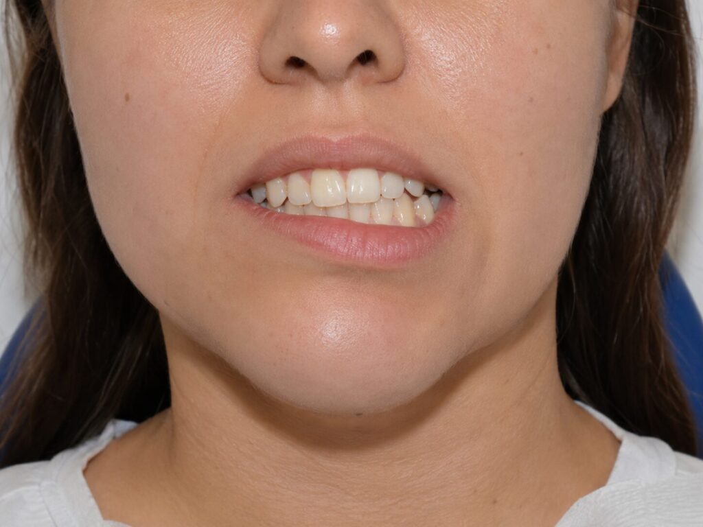 An asymmetrical jaw can be spotted over a clear aligner photo assessment - kohe™ Dental