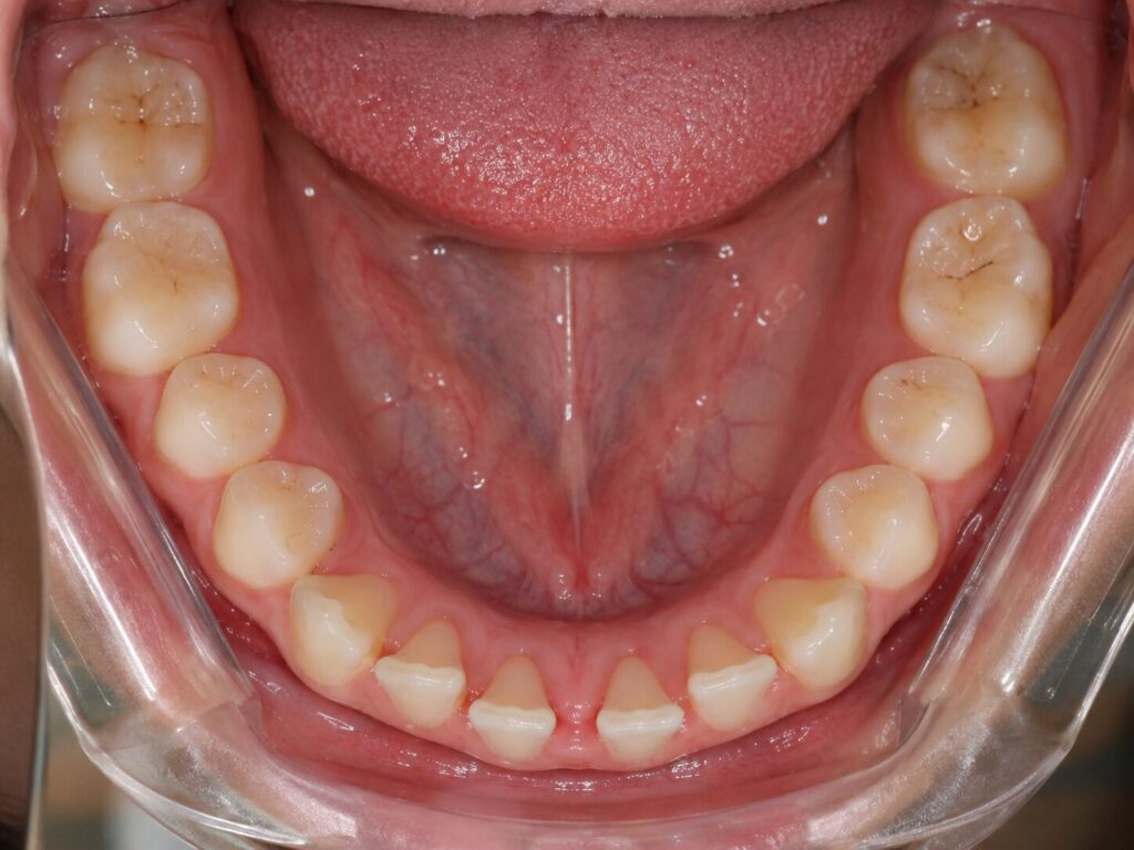 Gaps in teeth can be spotted over a clear aligner photo assessment - kohe™ Dental