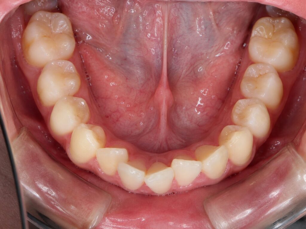 Crooked teeth can be spotted over a clear aligner photo assessment - kohe™ Dental