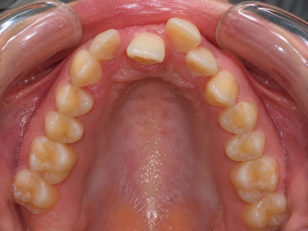 Rotated teeth can be spotted over a clear aligner photo assessment - kohe™ Dental