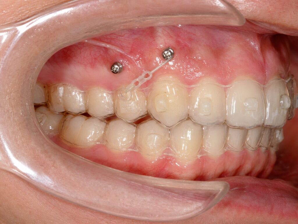 A clear aligner photo assessment can help determine whether you require further orthodontic appliances to support your clear aligner treatment - kohe™ Dental