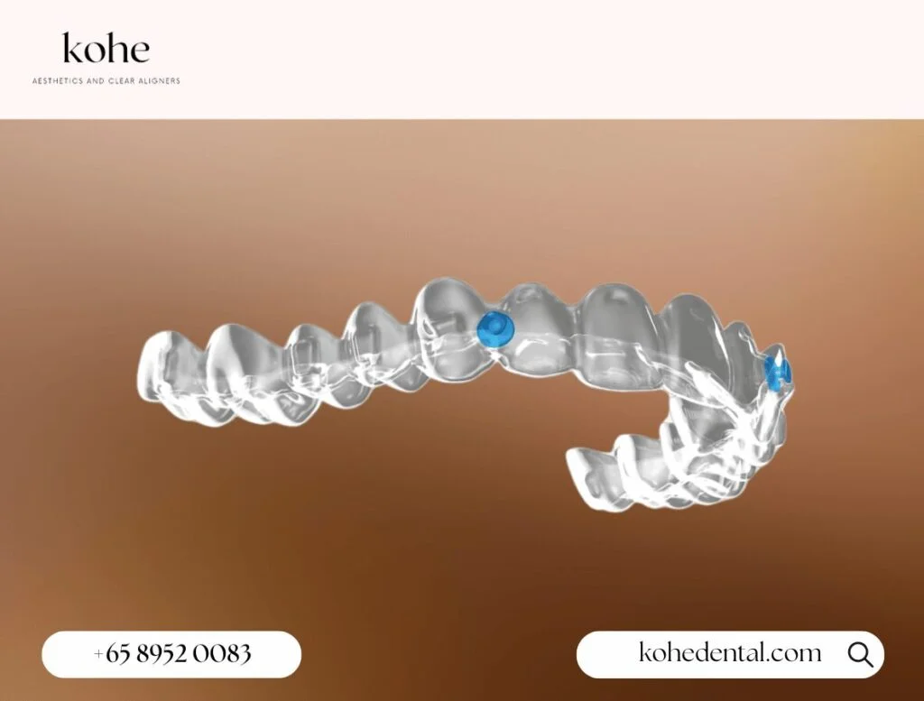 What Exactly Are Angel Aligners? 2 Angel Aligners - kohe Dental