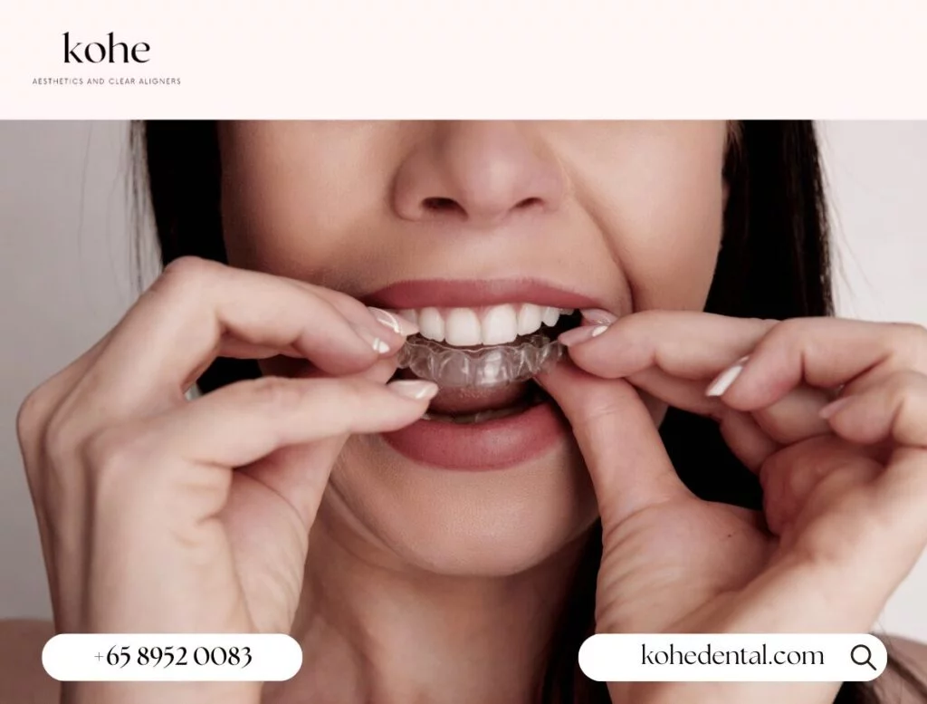 What Exactly Are Angel Aligners? 1 Woman wearing Angel Aligners clear aligners - kohe Dental