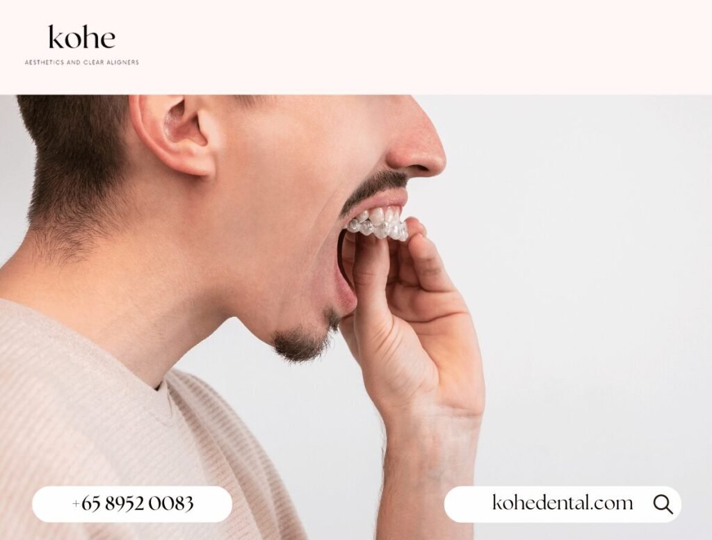 47 Things I Wish My Dentist Told Me Before I Got Invisalign 2 Guy Removing Clear Aligners From Teeth - kohe Dental