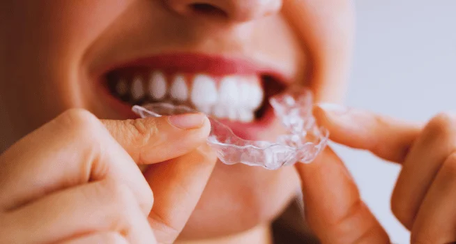 Woman Putting On Discreet Looking Invisible Braces (Clear Aligners) - kohe Dental