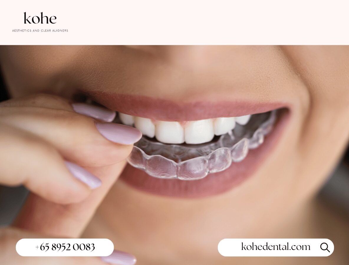 Do I Really Need To Wear My Aligners For 22 Hours A Day? 1 Woman Wearing Clear Aligners - kohe Dental