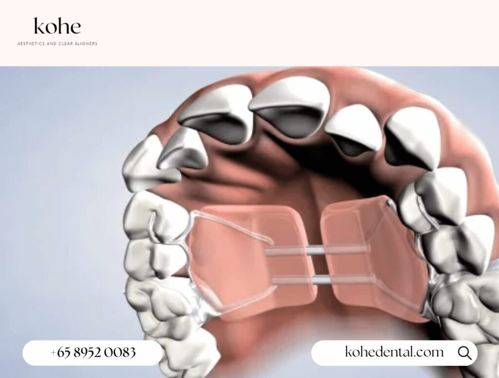 Invisalign Palatal Expanders (IPE): What Are They And How Do They Work? 2 Traditional Palatal Expanders - kohe Dental