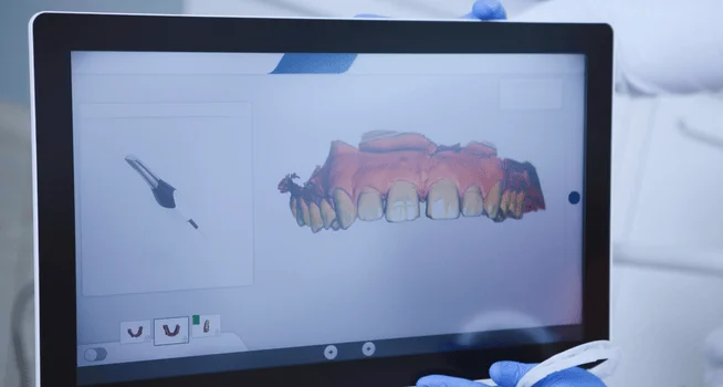 3D Scan of Teeth for Invisible Braces - kohe Dental