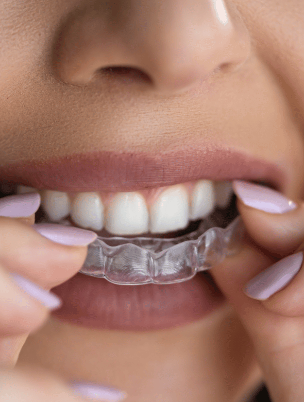 Invisible Braces 3 Woman Wearing On Invisible Braces - kohe Dental