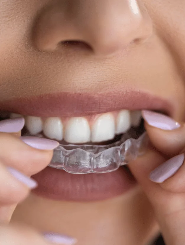 Woman Wearing On Invisible Braces - kohe Dental
