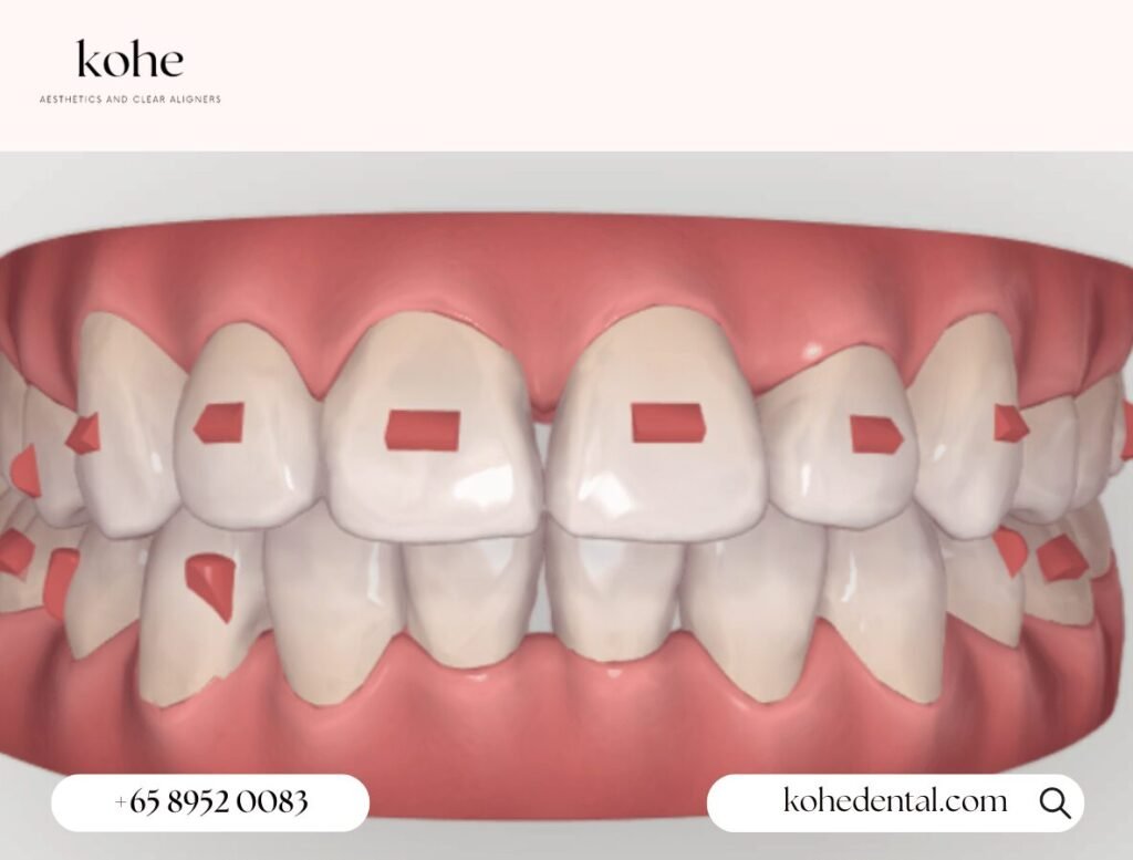 Pray Do Tell, What Are Attachments? 2 3D Model of Teeth Treatment Planning With Attachments Placed on Them - kohe Dental