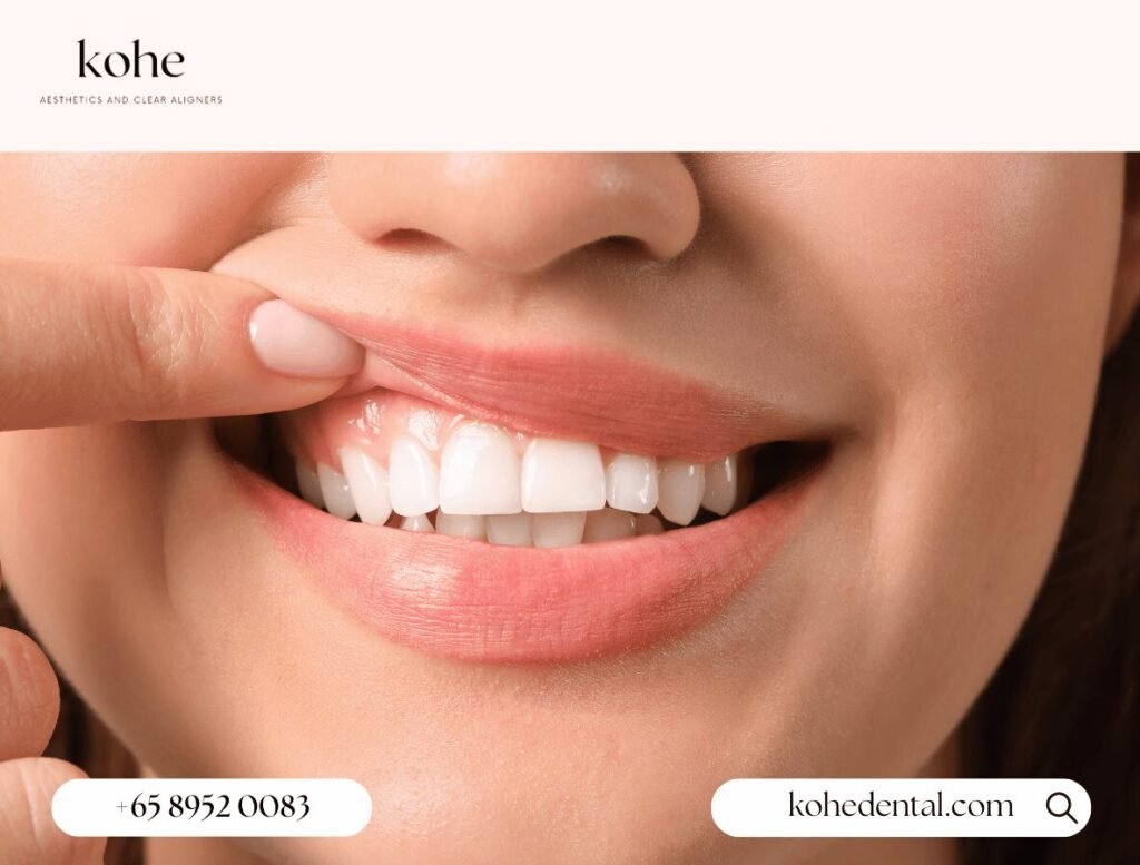 What is Orthodontic Relapse? 2 Prevent Orthodontic Relapse - kohe Dental