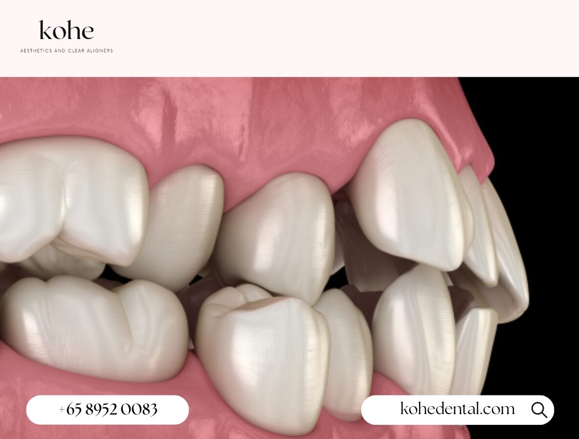What is Orthodontic Relapse? 1 Orthodontic Relapse - kohe Dental