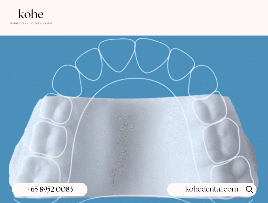 12 Things To Expect With The Invisalign Palatal Expander 1 The Invisalign Palatal Expander (IPE) - kohe Dental