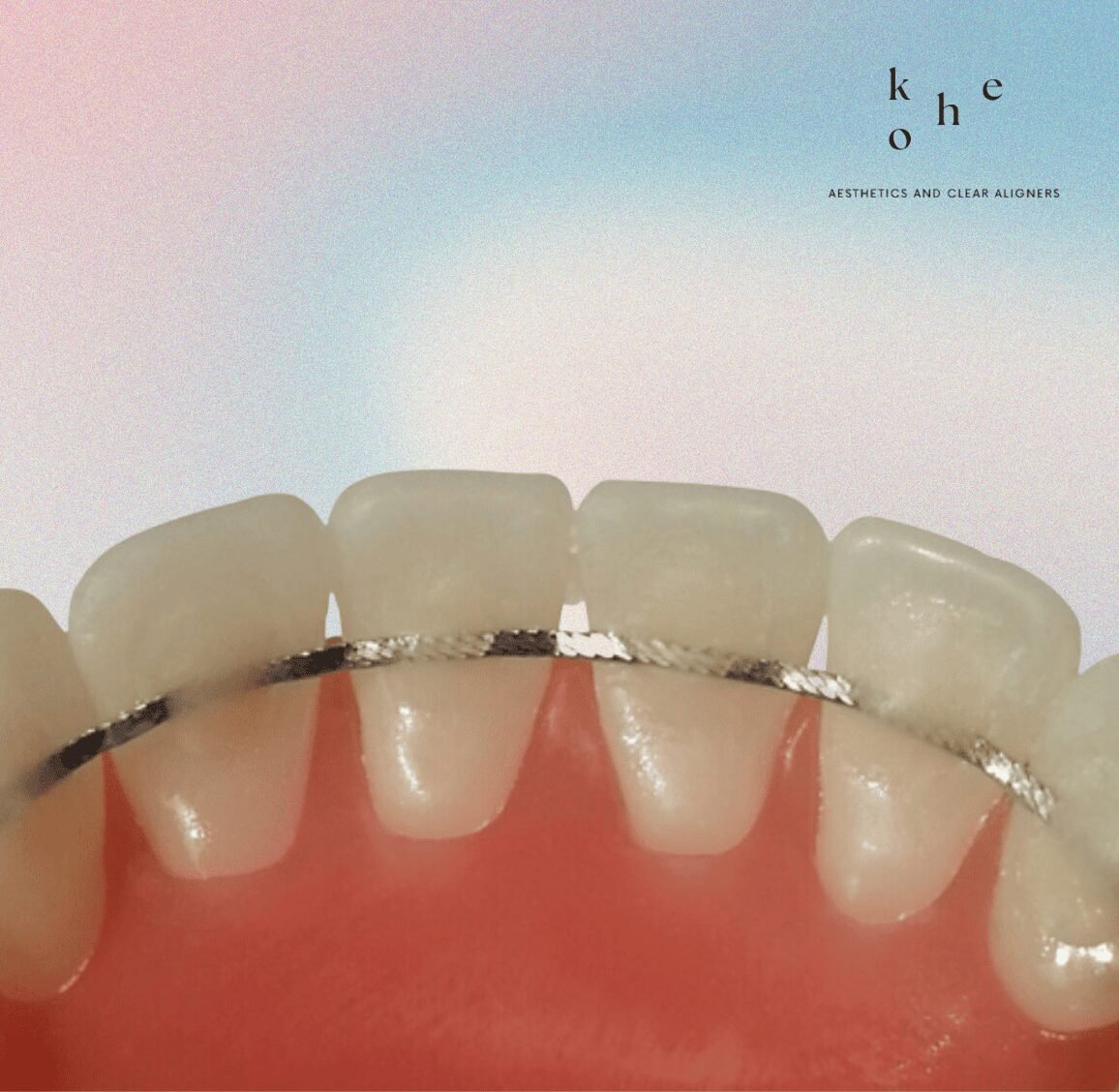 Metal Retainers 13 Fixed Bonded Retainers - kohe Dental
