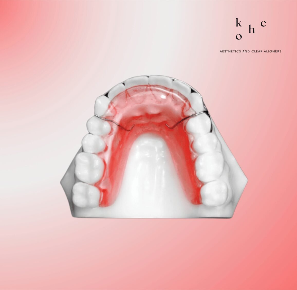 Metal Retainers 19 Hawley Retainers - kohe Dental