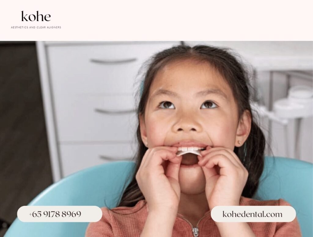 Invisalign Palatal Expander 1 Invisalign Palatal Expander (IPE) - kohe Dental