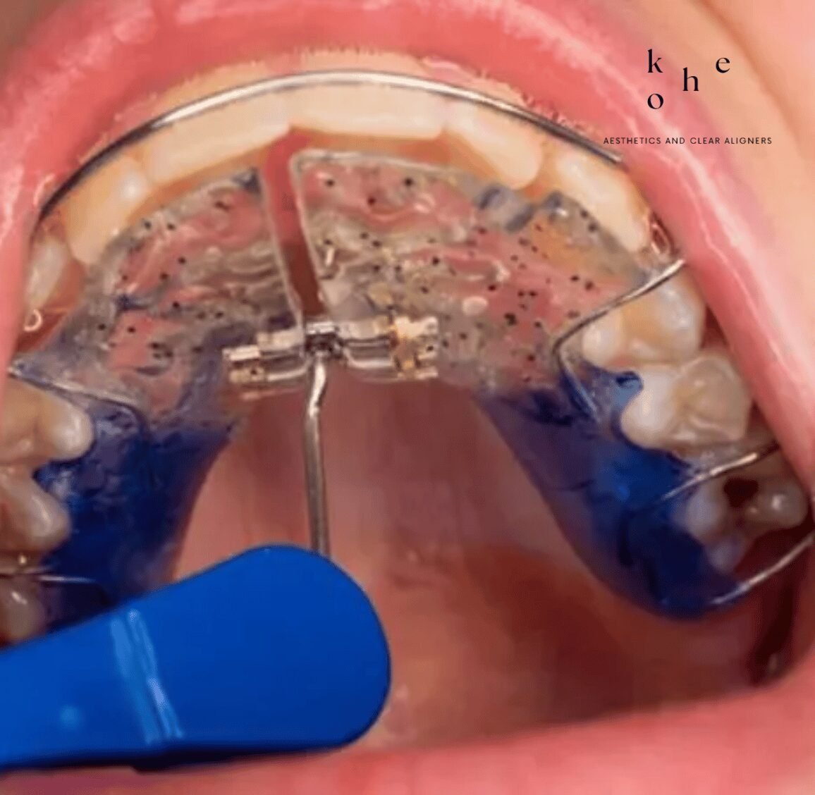 Metal Retainers 11 Metal Retainers Modifiable Design - kohe Dental