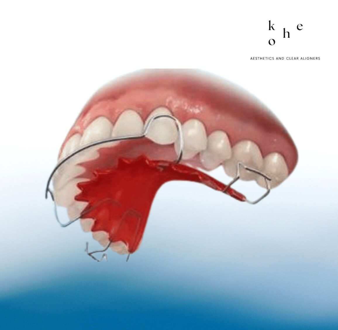 Metal Retainers 5 Metal Retainers Precisely Fitted on Teeth - kohe Dental