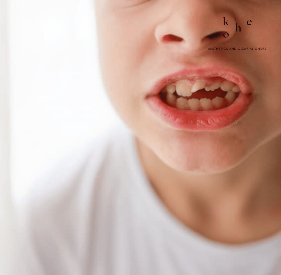 Invisalign First 6 Invisalign First Treats Orthodontic Conditions - kohe Dental
