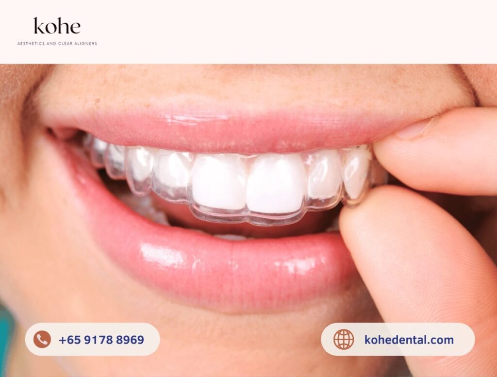 Common Questions I Get Asked About Retainers After Braces 1 Clear Retainers - kohe™ Dental