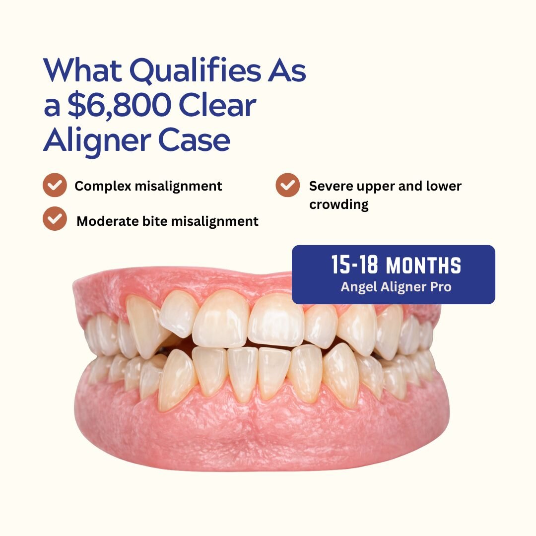 Angel Aligner Pro (1.5 Years) Unlimited Suitability - kohe™ Dental