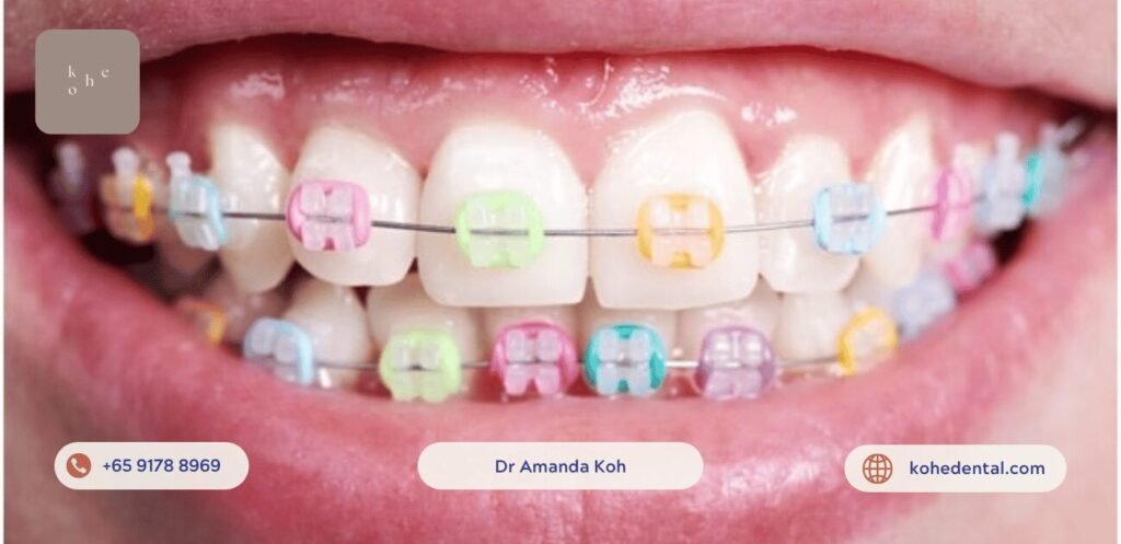 Affordable Braces Hack: Straighten Teeth on A Budget 3 Affordable Ceramic Braces with Coloured Elastics - kohe™ Dental