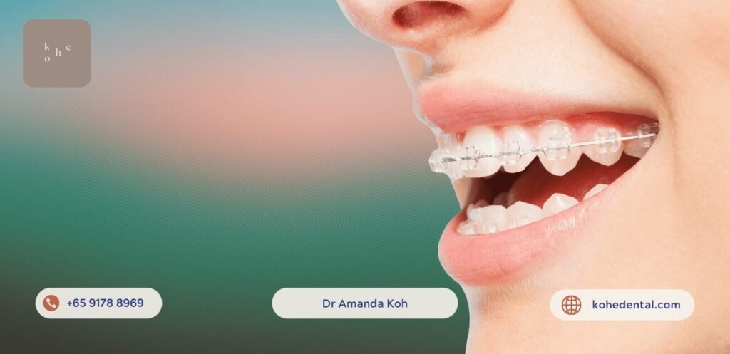 Affordable Braces Hack: Straighten Teeth on A Budget 6 Affordable Ceramic Self-Ligating Braces - kohe™ Dental