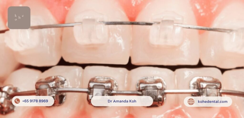 Affordable Braces Hack: Straighten Teeth on A Budget 5 Affordable Hybrid Braces - kohe™ Dental